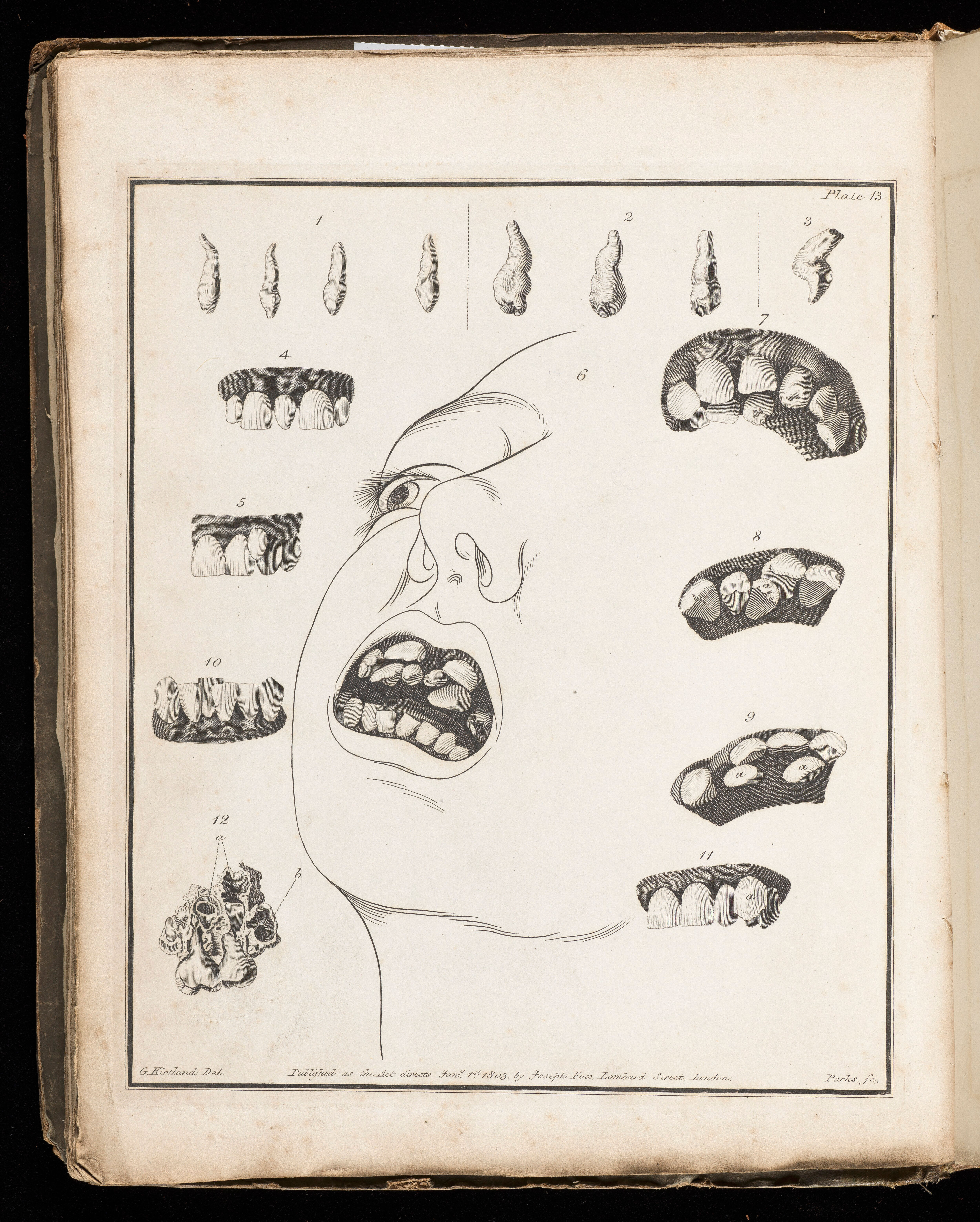 A case of “supernumerary” teeth from The natural history and diseases, of the human teeth: in two parts illustrated with twenty-three copper-plates by Joseph Fox, 1814. A case of “supernumerary” teeth from The natural history and diseases, of the human teeth: in two parts illustrated with twenty-three copper-plates by Joseph Fox, 1814.