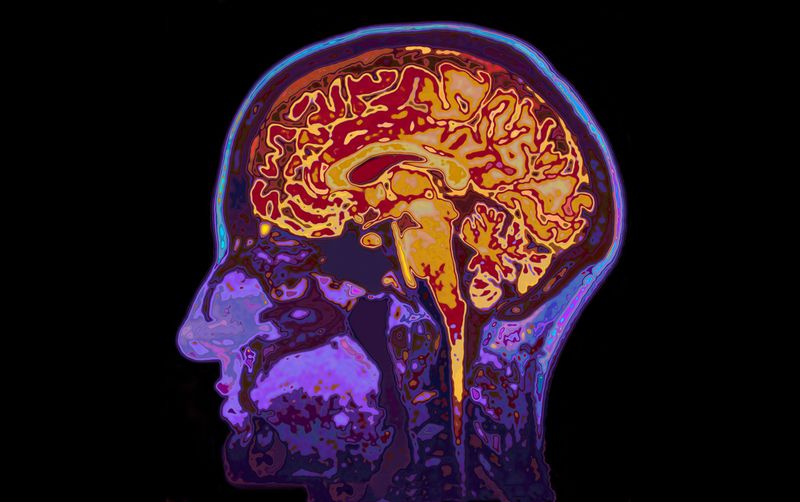 Brain ageing.