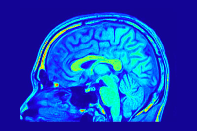 A photo of a brain scan showing the profile view of the brain in a person's skull. The scan is made up of various shades of blue giving the structure of the brain and its surroundings. 