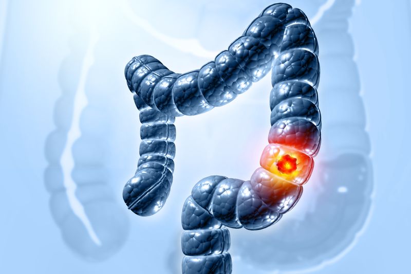 A 3D render of a large intestine with a tumor glowing in red