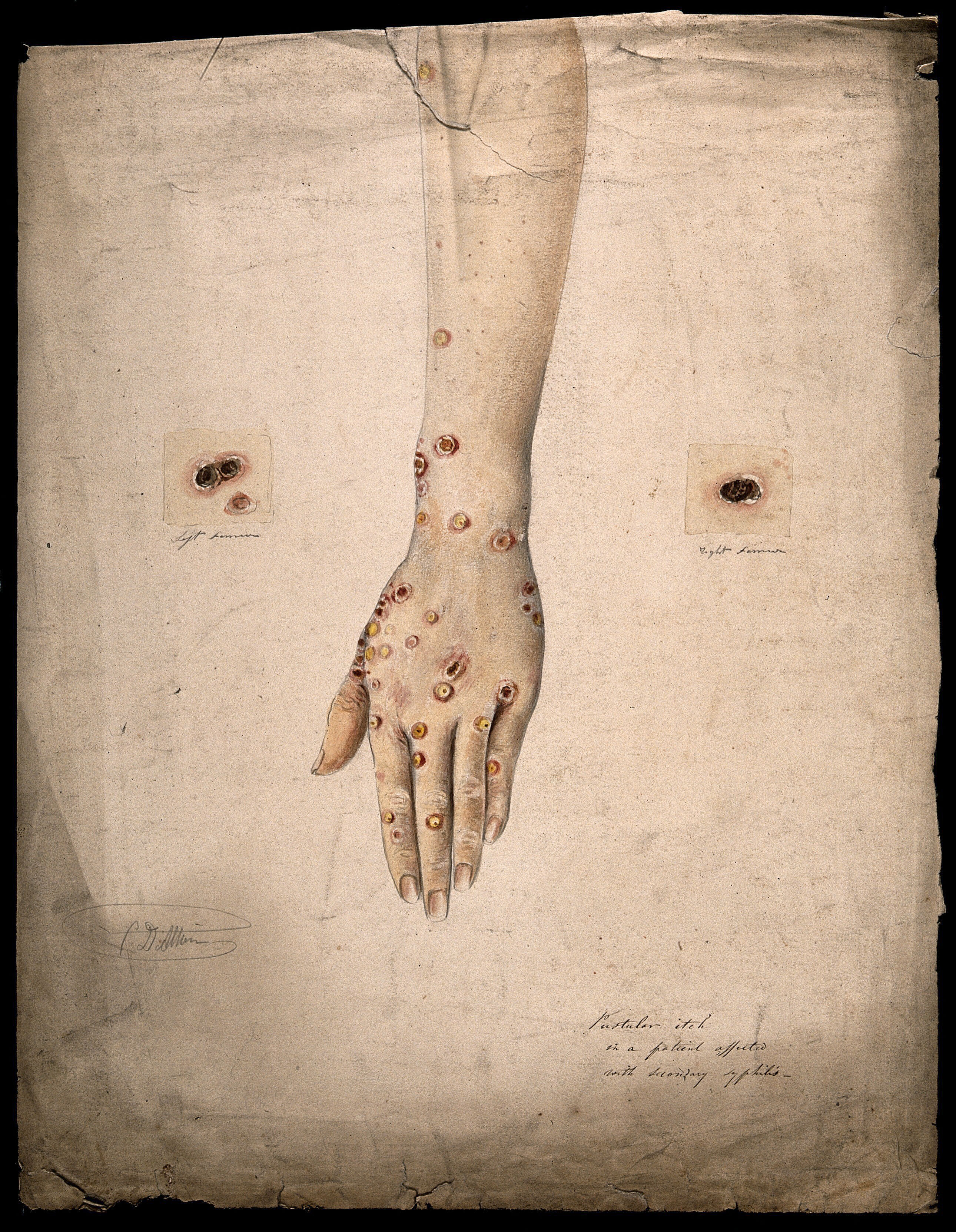 A 19th century watercolor illustration showing syphilis sores on a woman's arm. The sores are mostly located on around her hand and wrist but a few examples extend up her arm. The artist has added two close up examples of the sores either side of the arm to show what they look like in detail. A 19th century watercolor illustration showing syphilis sores on a woman's arm. The sores are mostly located on around her hand and wrist but a few examples extend up her arm. The artist has added two close up examples of the sores either side of the arm to show what they look like in detail.