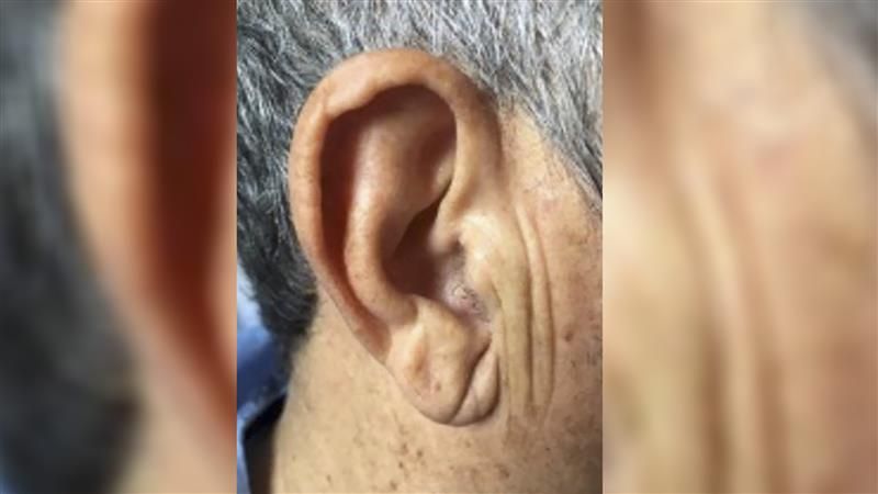 A photo showing an older person's ear demonstrating the deep crease of their lower right hand earlobe.