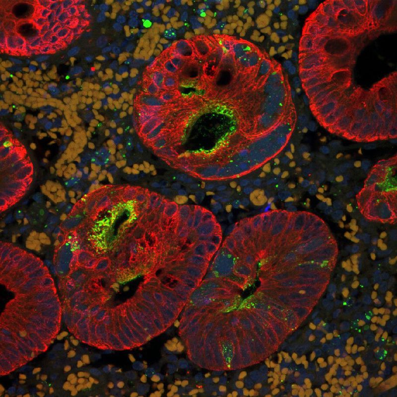 colourful microscopy image showing appendix cells infected with fluorescently labelled measles virus