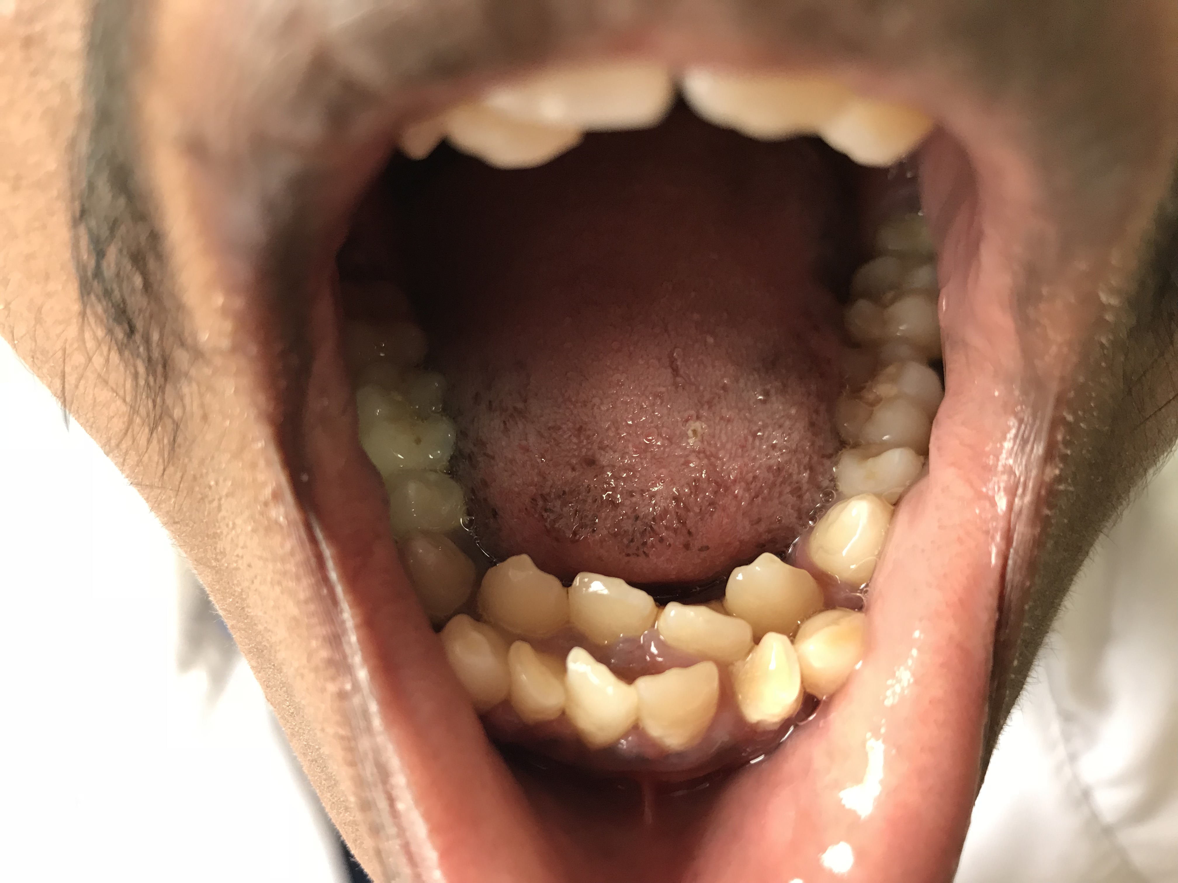 Hyperdontia can present as an extra row of teeth like this.