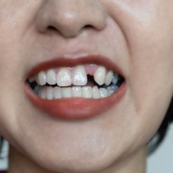 Woman's teeth, missing teeth, dental health.